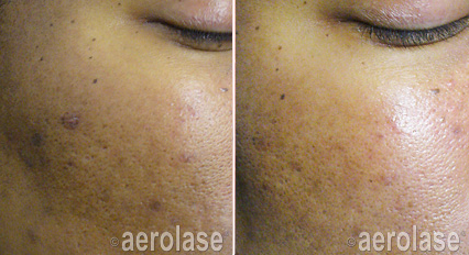 Pigmented spots before and after Aerolase Neo Elite treatment
