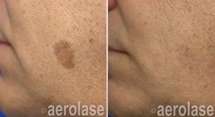 Pigmented spots before and after Aerolase Neo Elite treatment
