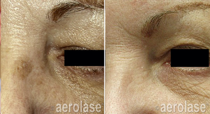 Pigmented spots before and after Aerolase Neo Elite treatment