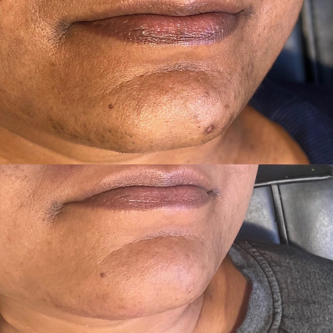 Hyperpigmentation before and after Aerolase Neo Elite treatment