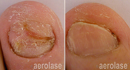 Nail fungus before and after Aerolase Neo Elite treatment