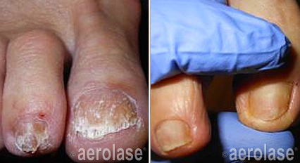 Nail fungus before and after Aerolase Neo Elite treatment