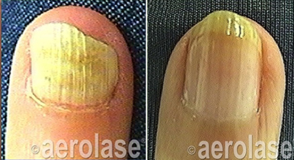 Nail fungus before and after Aerolase Neo Elite treatment