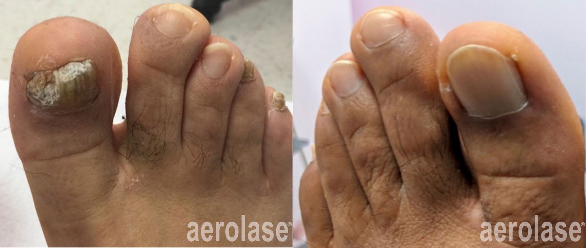 Nail fungus before and after Aerolase Neo Elite treatment