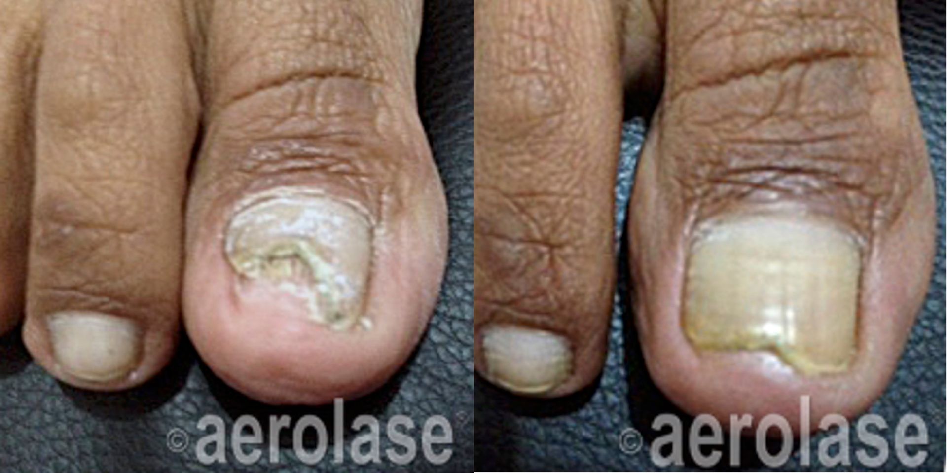 Nail fungus before and after Aerolase Neo Elite treatment