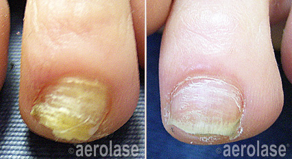 Nail fungus before and after Aerolase Neo Elite treatment
