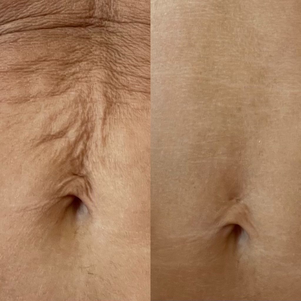 Aerolase Neo Elite laser treatments at VIOSA Aesthetics MD