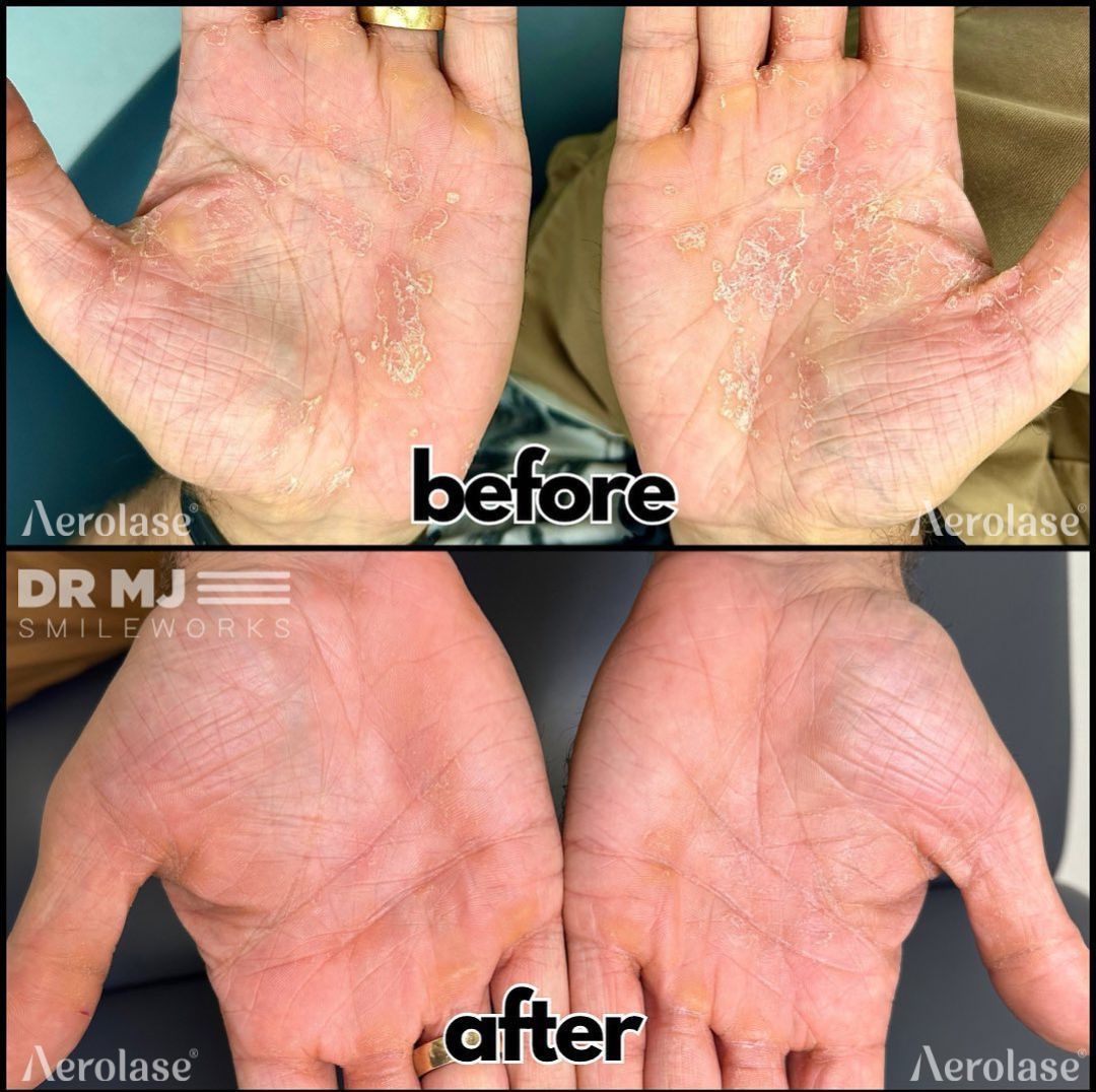 Psoriasis on the hands before and after Aerolase Neo Elite treatment
