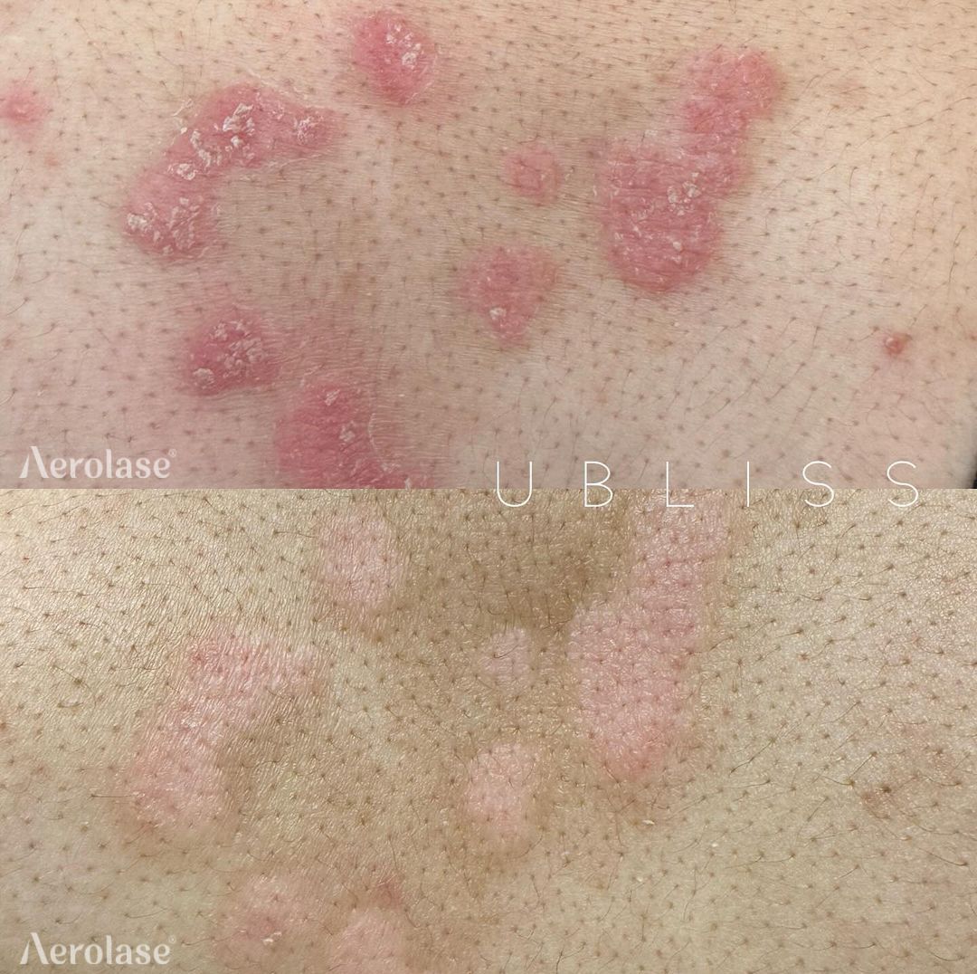 Psoriasis before and after Aerolase Neo Elite treatment