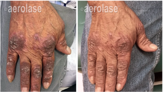 Psoriasis before and after Aerolase Neo Elite treatment