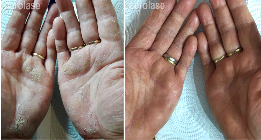 Psoriasis, 4 weeks post treatment before and after Aerolase Neo Elite treatment