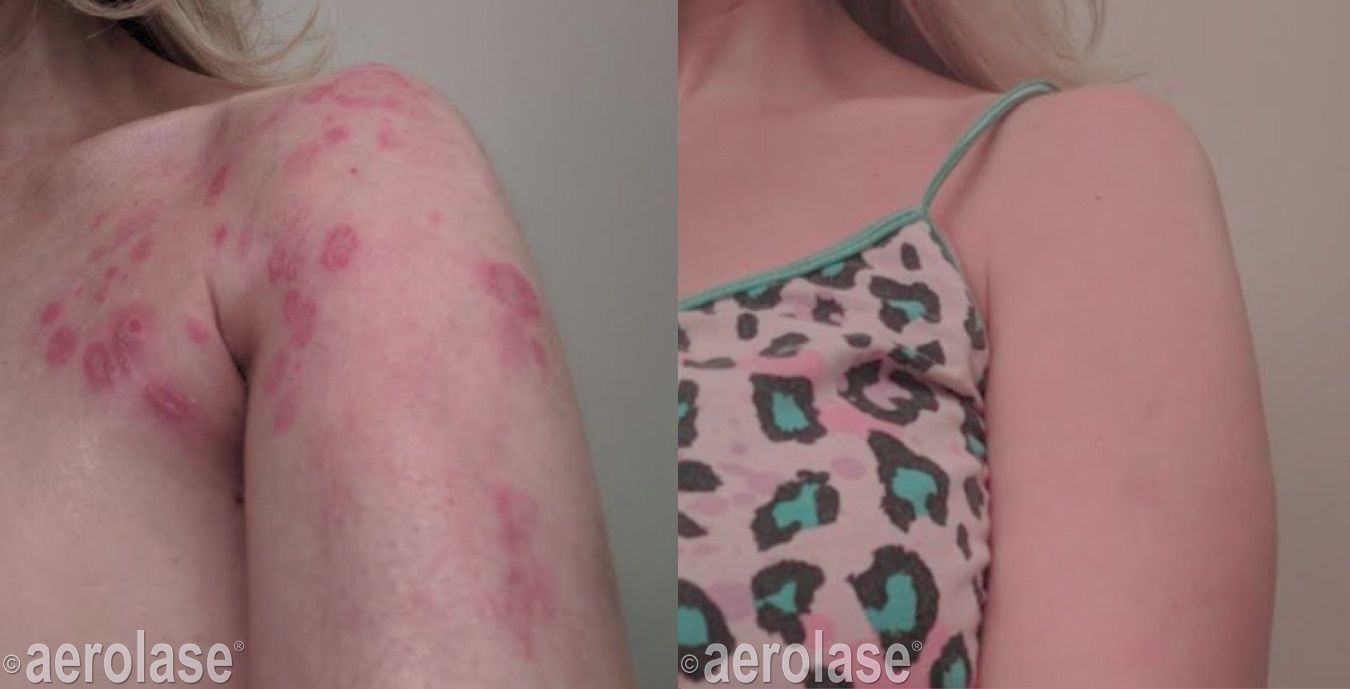 Psoriasis on the shoulder before and after Aerolase Neo Elite treatment