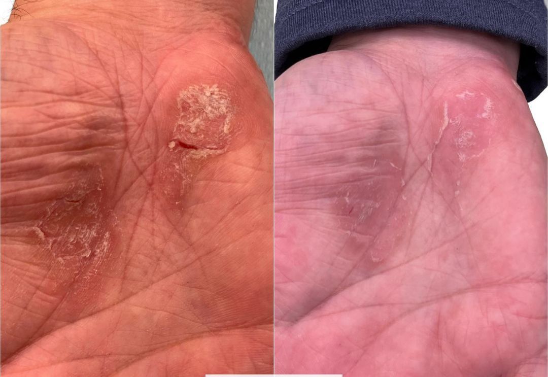 Psoriasis before and after Aerolase Neo Elite treatment