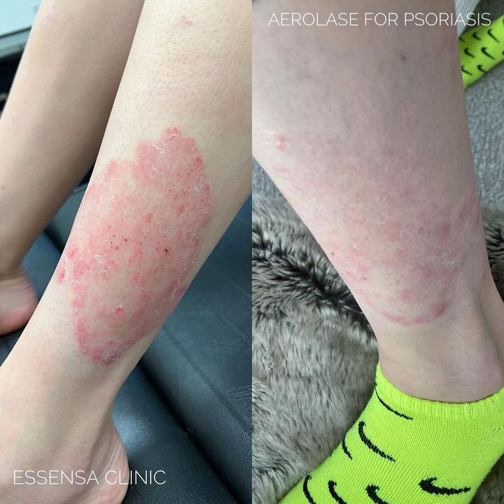 Psoriasis before and after Aerolase Neo Elite treatment