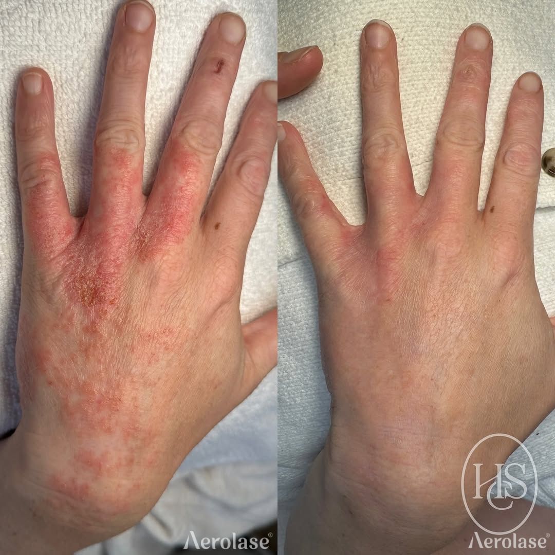 Psoriasis on the hands before and after Aerolase Neo Elite treatment