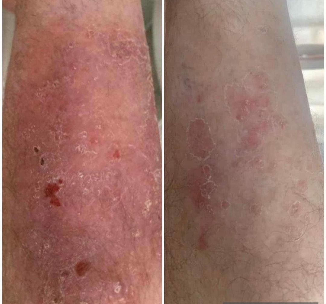 Psoriasis before and after Aerolase Neo Elite treatment