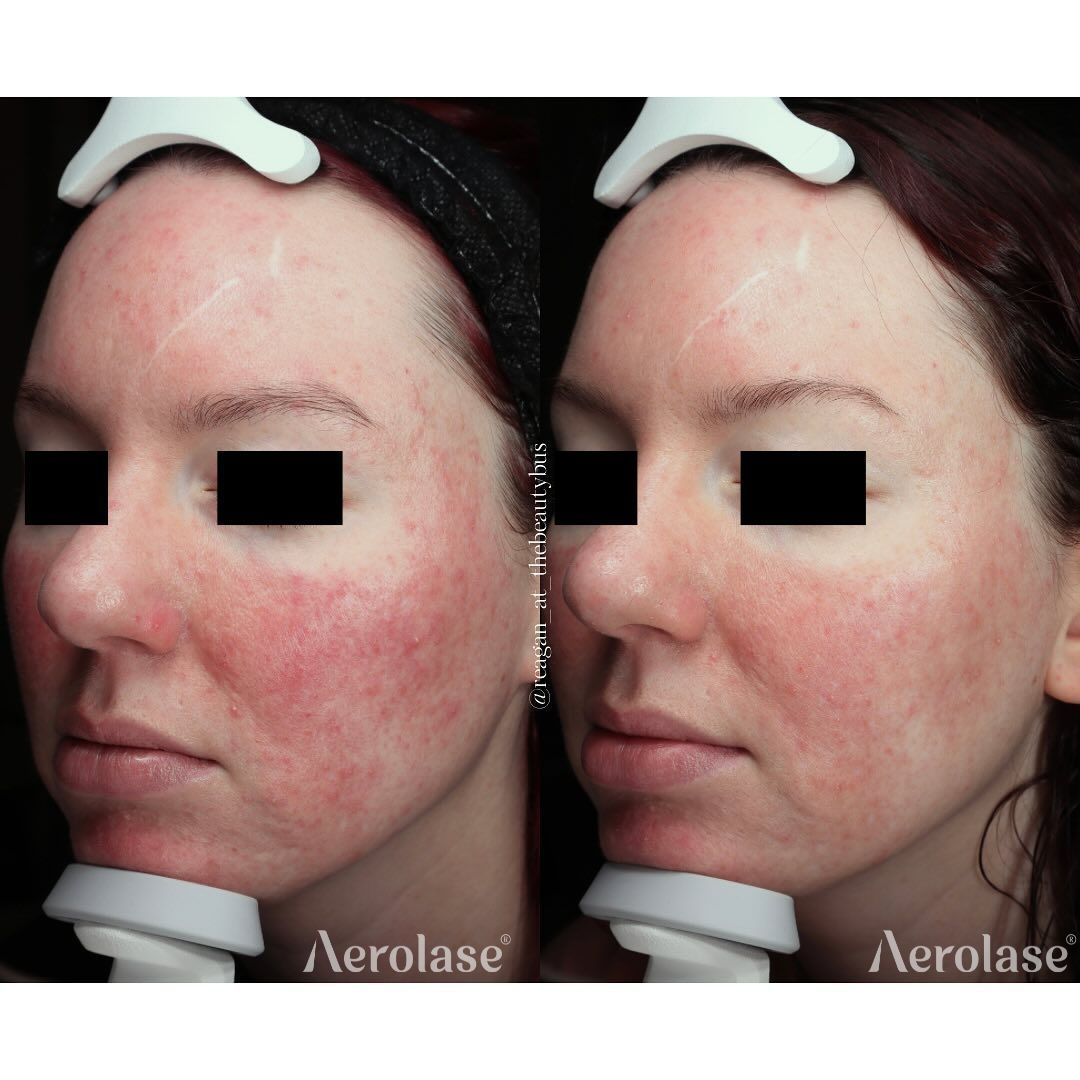 Rosacea before and after Aerolase Neo Elite treatment