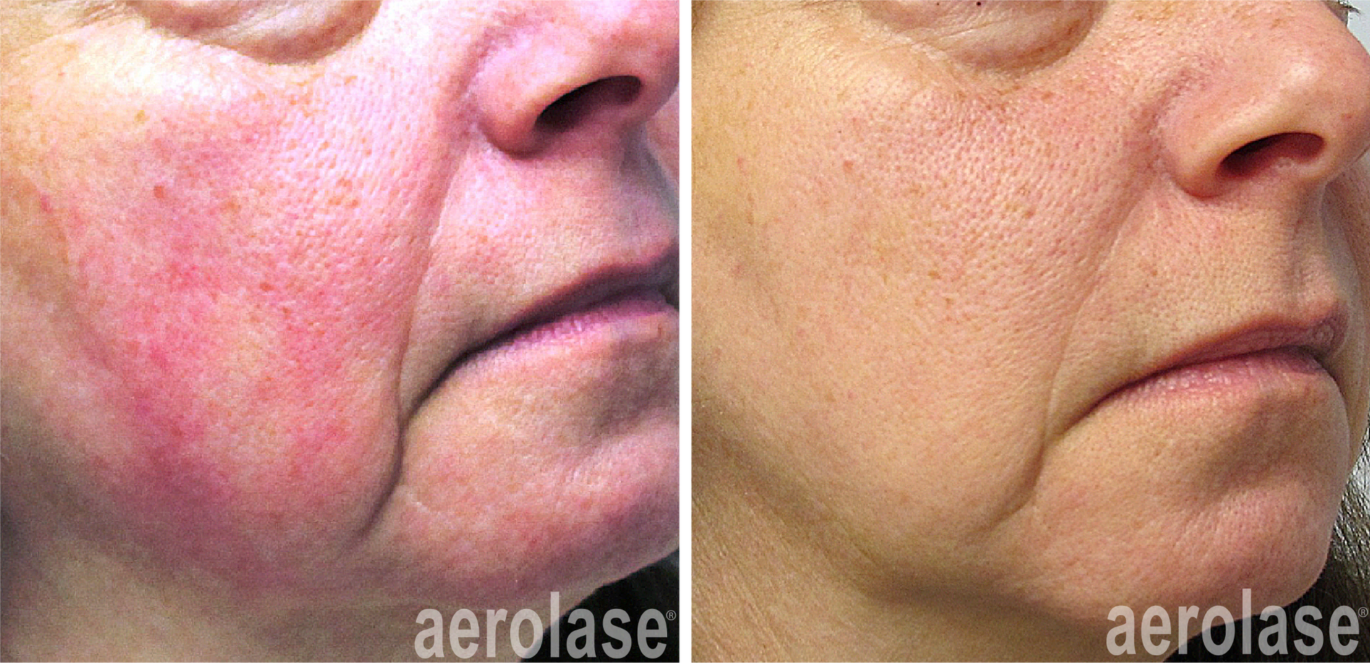 Rosacea before and after Aerolase Neo Elite treatment
