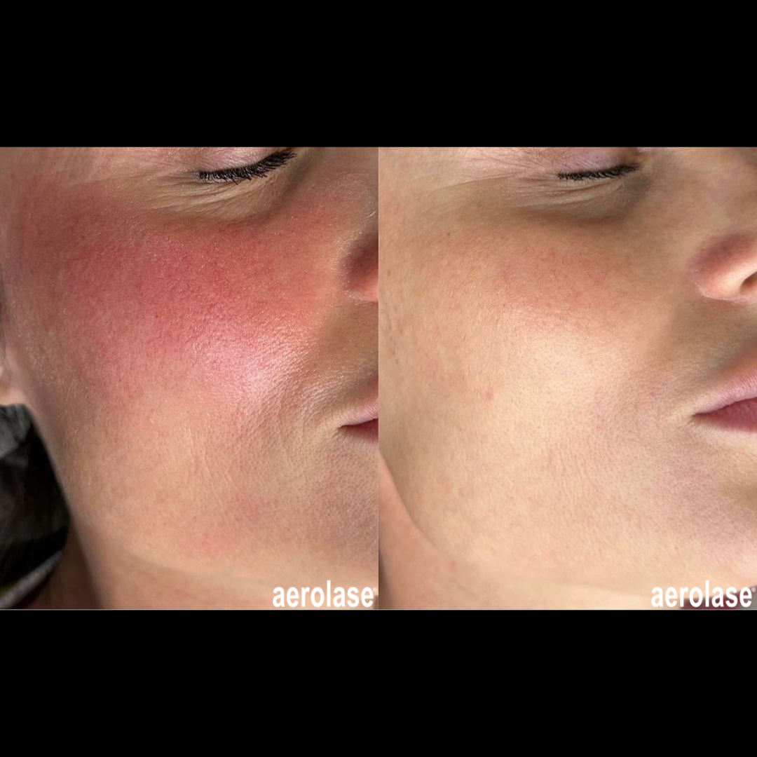 Rosacea before and after Aerolase Neo Elite treatment