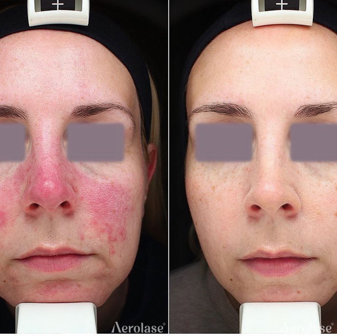 Rosacea before and after Aerolase Neo Elite treatment