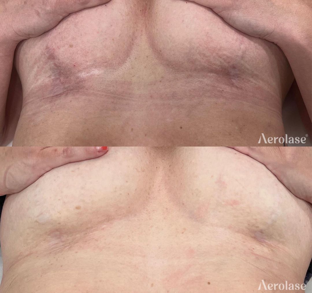 Scar reduction before and after Aerolase Neo Elite treatment