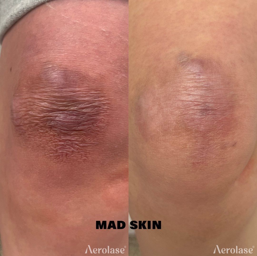 Scars before and after Aerolase Neo Elite treatment