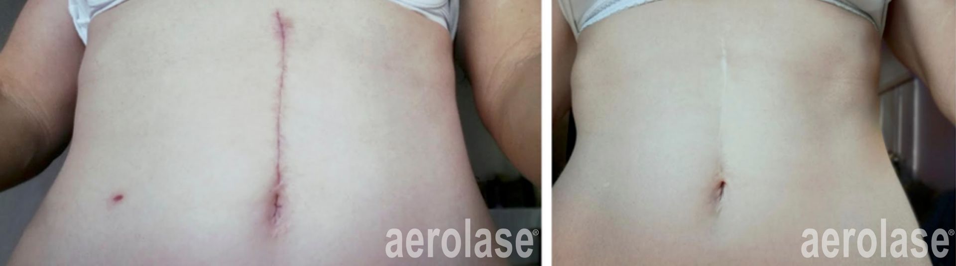 Post surgical scars before and after Aerolase Neo Elite treatment