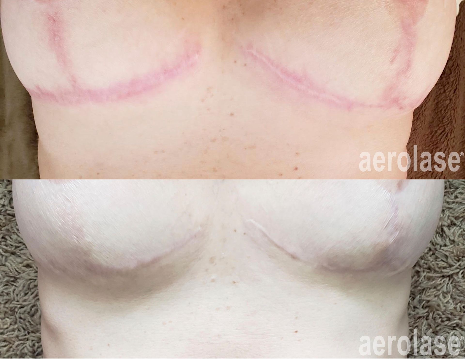 Post surgical scars before and after Aerolase Neo Elite treatment
