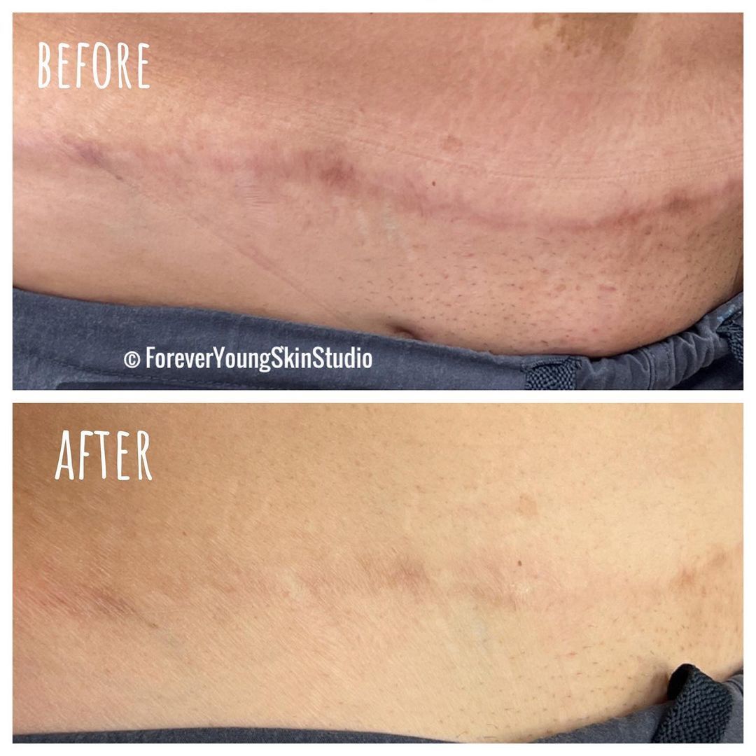 Scar reduction before and after Aerolase Neo Elite treatment