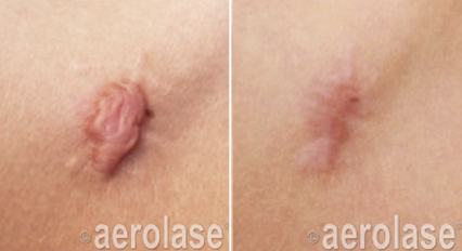 Scar reduction before and after Aerolase Neo Elite treatment