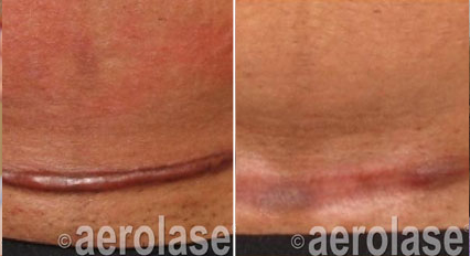 Scar revision before and after Aerolase Neo Elite treatment