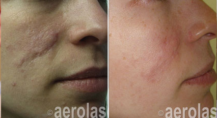 Scar revision before and after Aerolase Neo Elite treatment