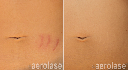 Scar revision before and after Aerolase Neo Elite treatment