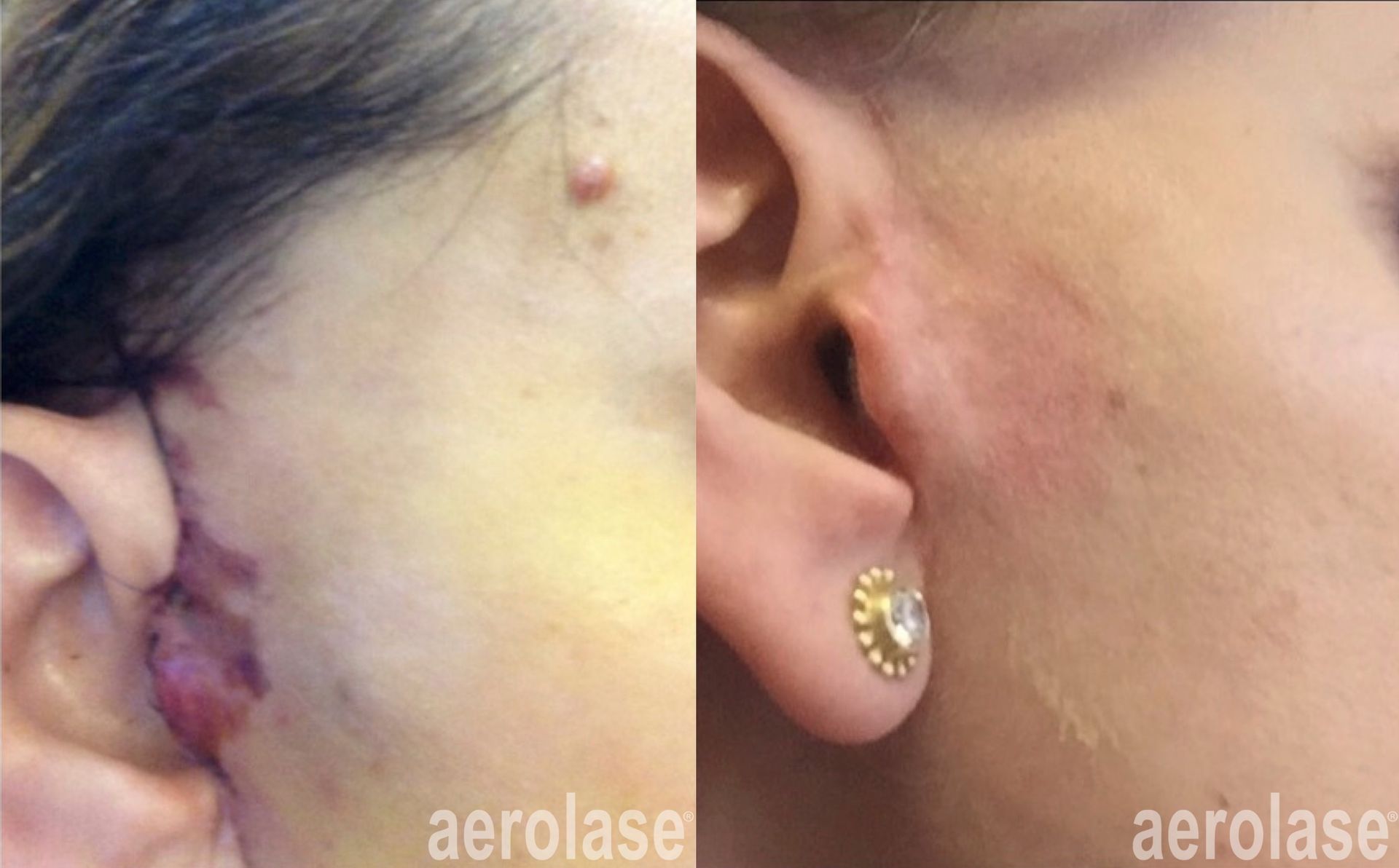 Post surgical scars before and after Aerolase Neo Elite treatment