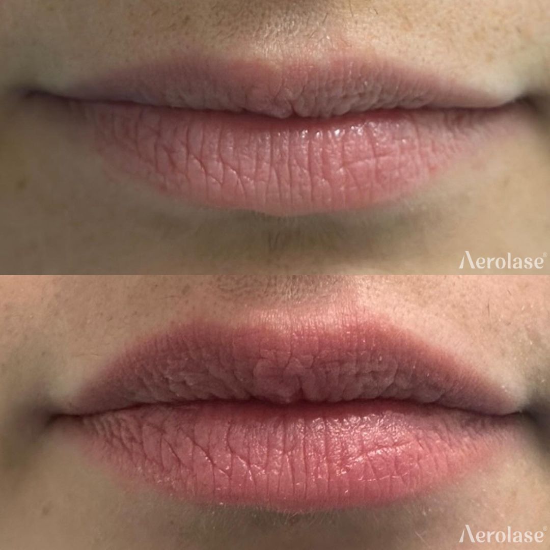 Lip rejuvenation before and after Aerolase Neo Elite treatment