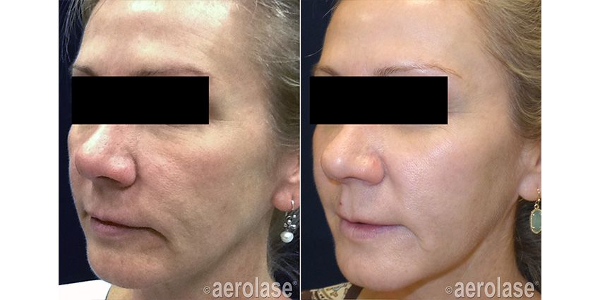 Skin rejuvenation before and after Aerolase Neo Elite treatment