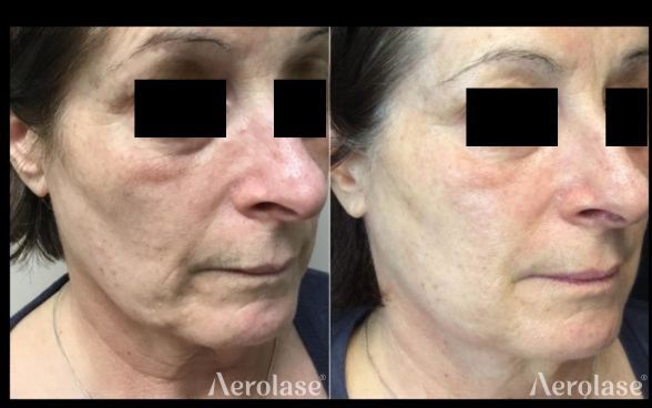 Skin rejuvenation on the face before and after Aerolase Neo Elite treatment
