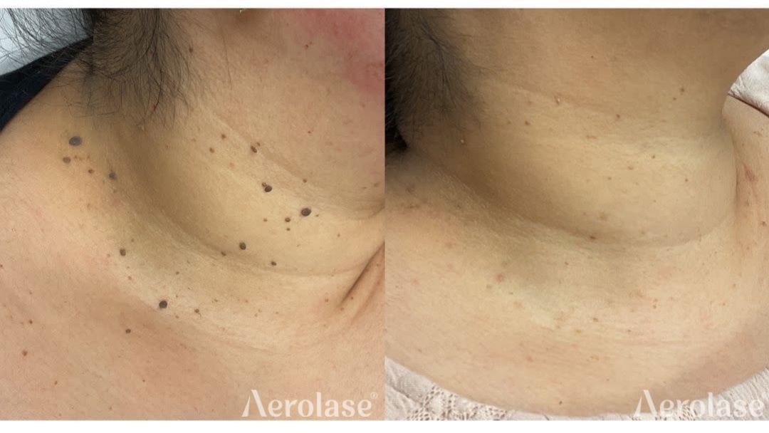 Skin tags before and after Aerolase Neo Elite treatment