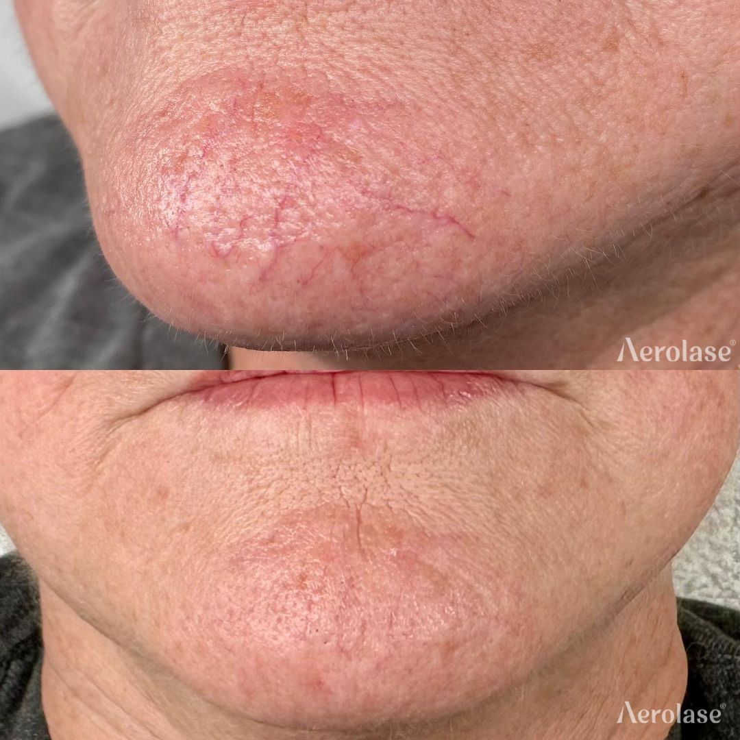Veins and spider veins before and after Aerolase Neo Elite treatment