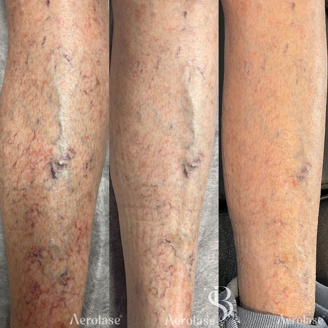 Spider veins on the leg before and after Aerolase Neo Elite treatment