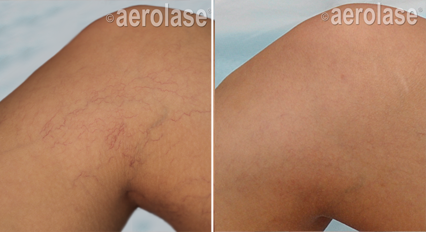 Spider veins before and after Aerolase Neo Elite treatment