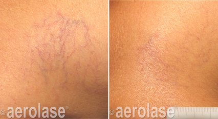 Spider veins before and after Aerolase Neo Elite treatment