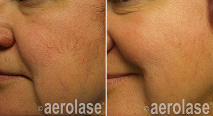 Spider veins before and after Aerolase Neo Elite treatment
