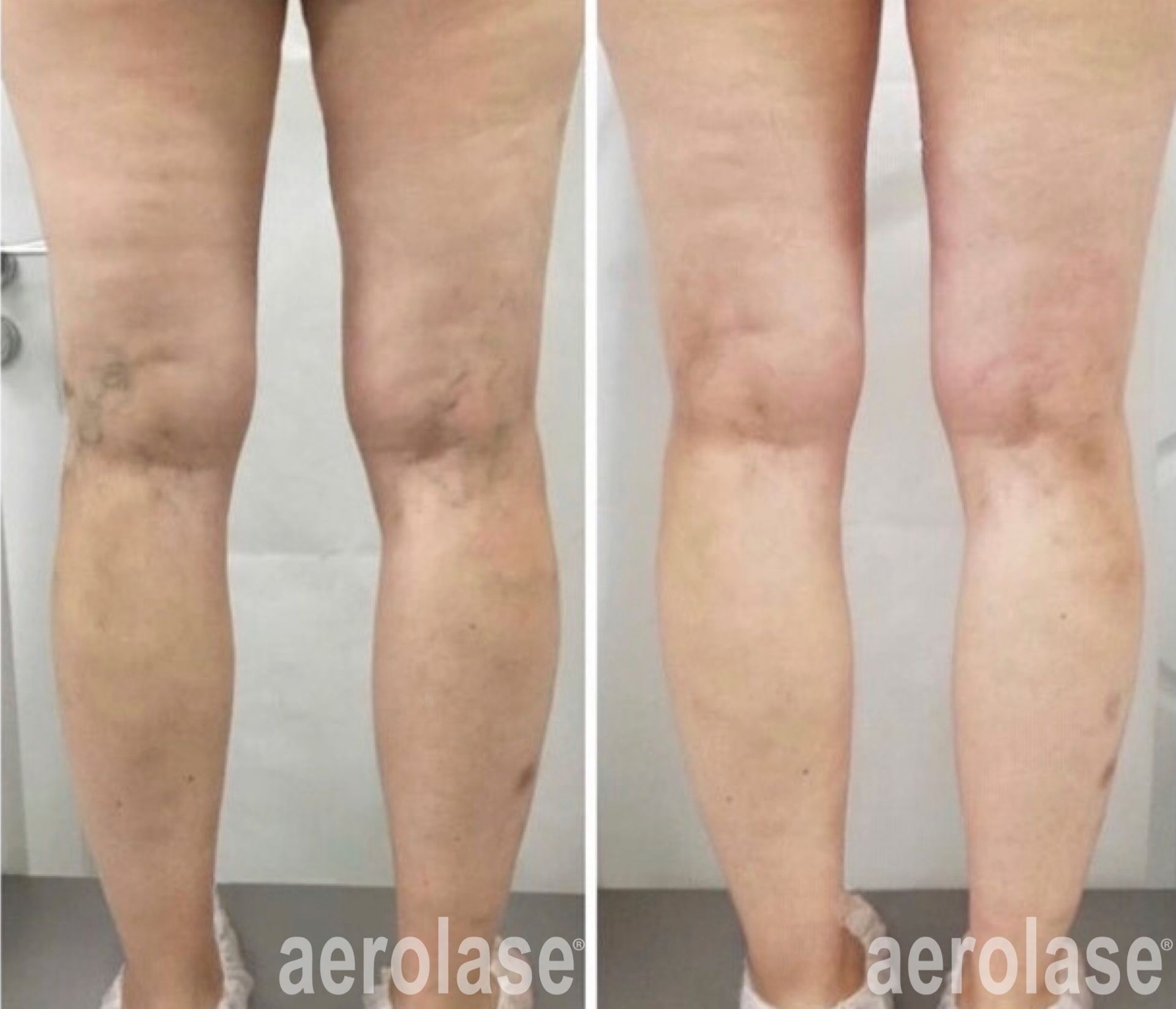 Leg veins before and after Aerolase Neo Elite treatment