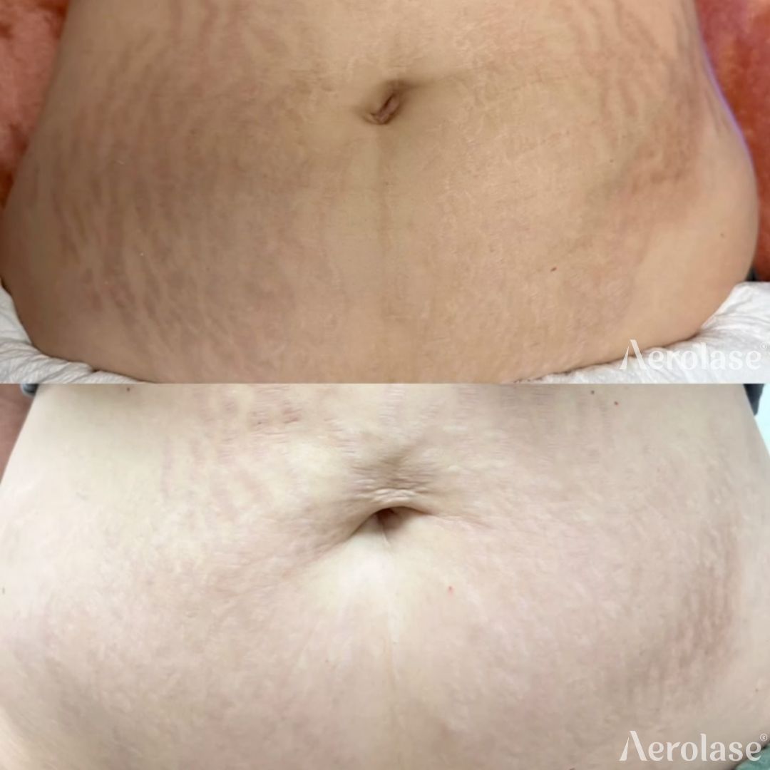 Stretch marks on the stomach before and after Aerolase Neo Elite treatment