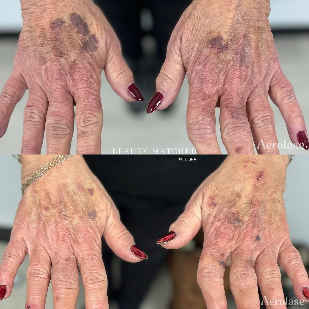 Bruising, age spots, sun damage, fine lines and wrinkles before and after Aerolase Neo Elite treatment