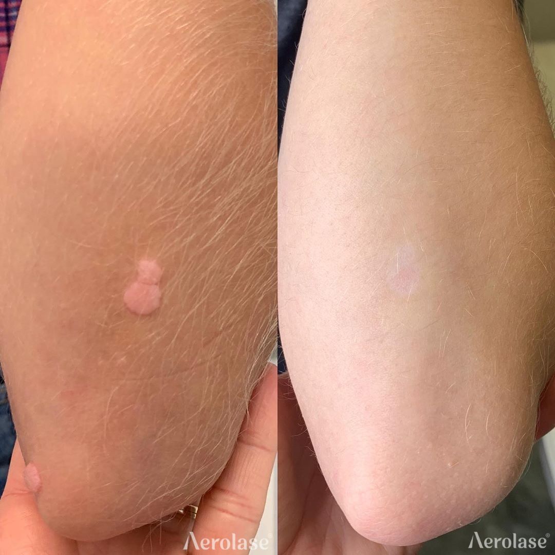 Warts before and after Aerolase Neo Elite treatment