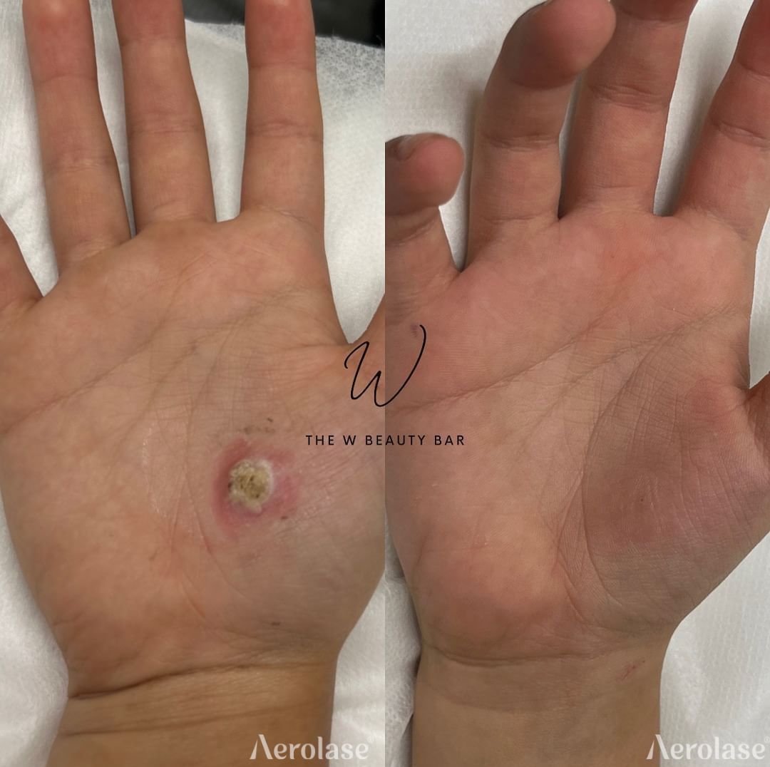 Warts before and after Aerolase Neo Elite treatment