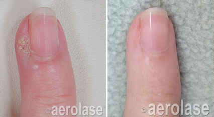 Warts before and after Aerolase Neo Elite treatment