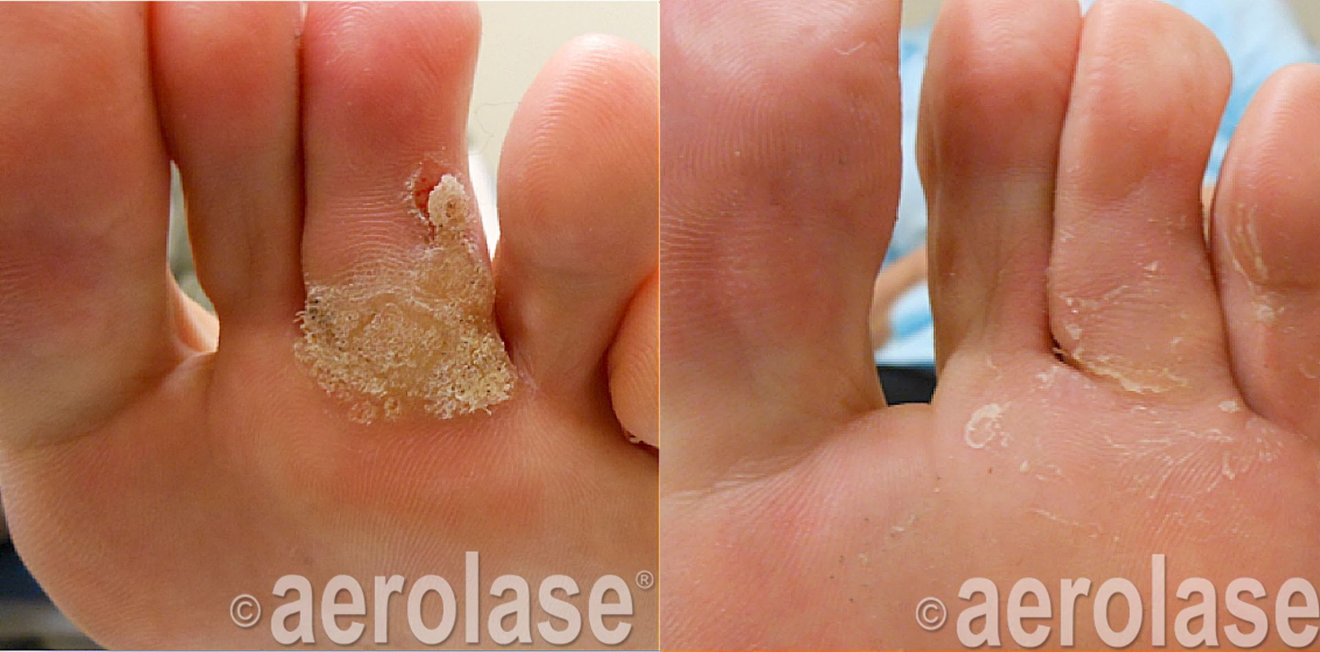 Warts before and after Aerolase Neo Elite treatment